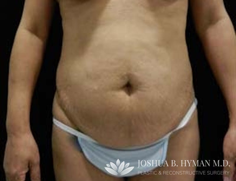 Abdominoplasty Before & After Gallery - Patient 58232373 - Image 1
