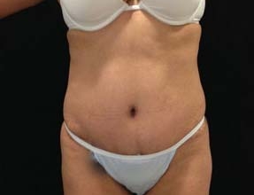 Abdominoplasty Before & After Gallery - Patient 58232373 - Image 2