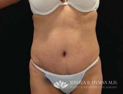 Abdominoplasty Before & After Gallery - Patient 58232373 - Image 2