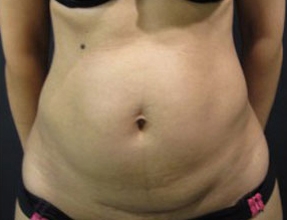 Liposuction Before & After Gallery - Patient 58232377 - Image 1