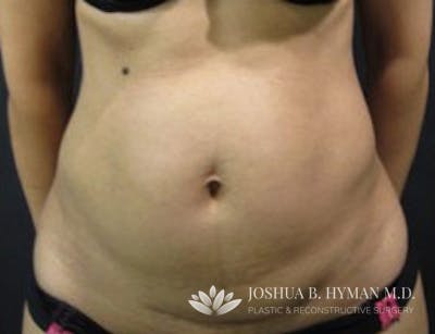Liposuction Before & After Gallery - Patient 58232377 - Image 1