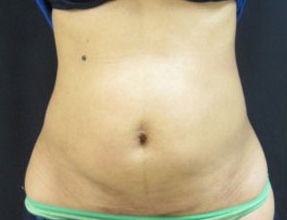 Liposuction Before & After Gallery - Patient 58232377 - Image 2