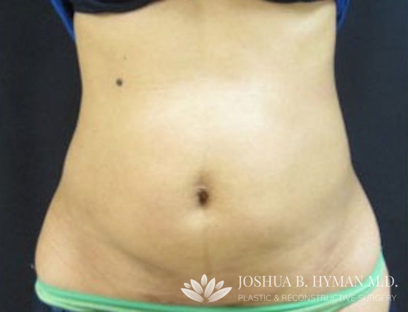 Liposuction Before & After Gallery - Patient 58232377 - Image 2