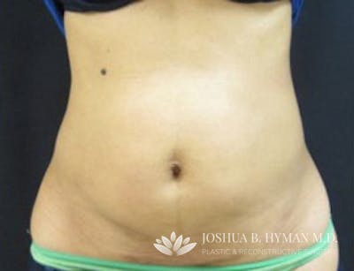 Liposuction Before & After Gallery - Patient 58232377 - Image 2