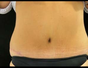 Abdominoplasty Before & After Gallery - Patient 58232380 - Image 2