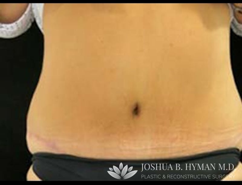 Abdominoplasty Before & After Gallery - Patient 58232380 - Image 2