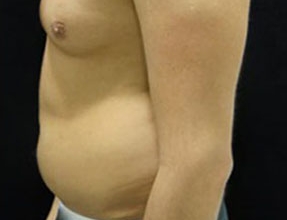 Liposuction Before & After Gallery - Patient 58232382 - Image 1