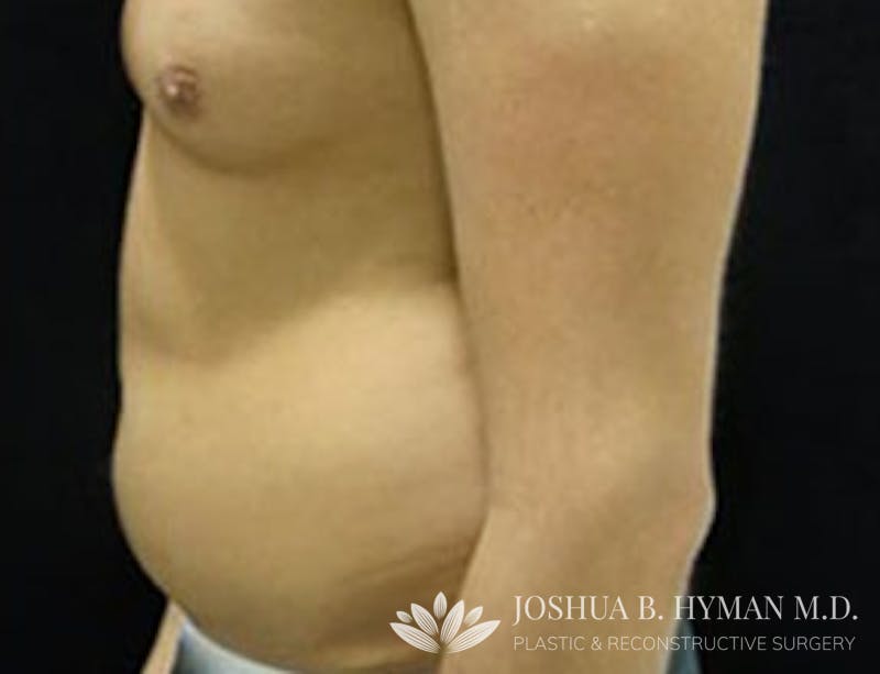 Liposuction Before & After Gallery - Patient 58232382 - Image 1