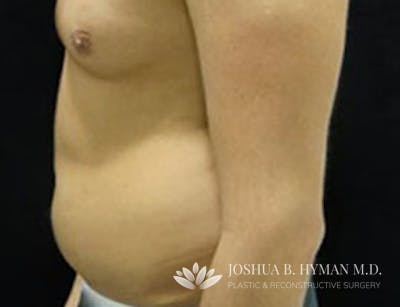 Liposuction Before & After Gallery - Patient 58232382 - Image 1
