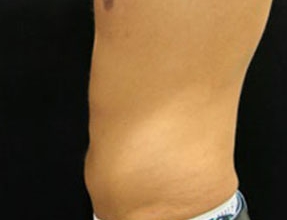 Liposuction Before & After Gallery - Patient 58232382 - Image 2