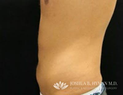 Liposuction Before & After Gallery - Patient 58232382 - Image 2