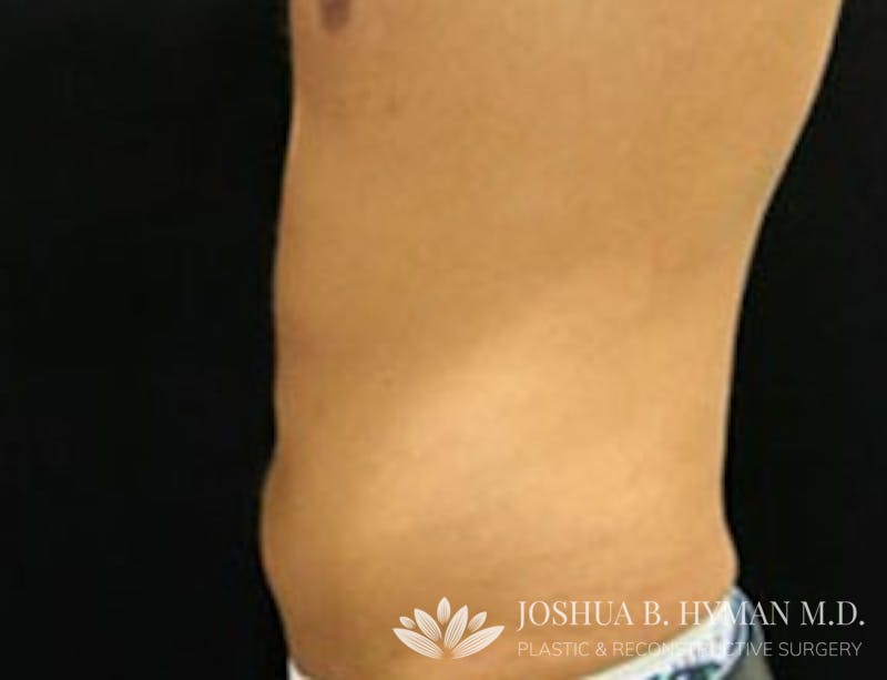 Liposuction Before & After Gallery - Patient 58232382 - Image 2