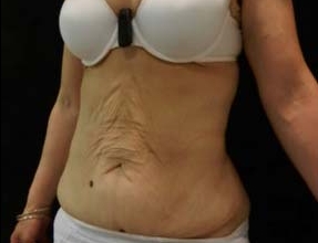 Abdominoplasty Before & After Gallery - Patient 58232383 - Image 1