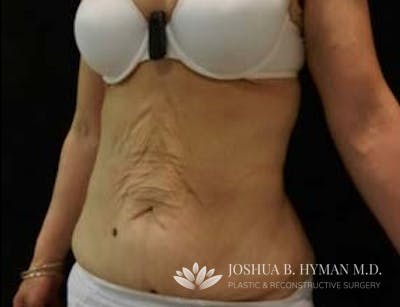 Abdominoplasty Before & After Gallery - Patient 58232383 - Image 1