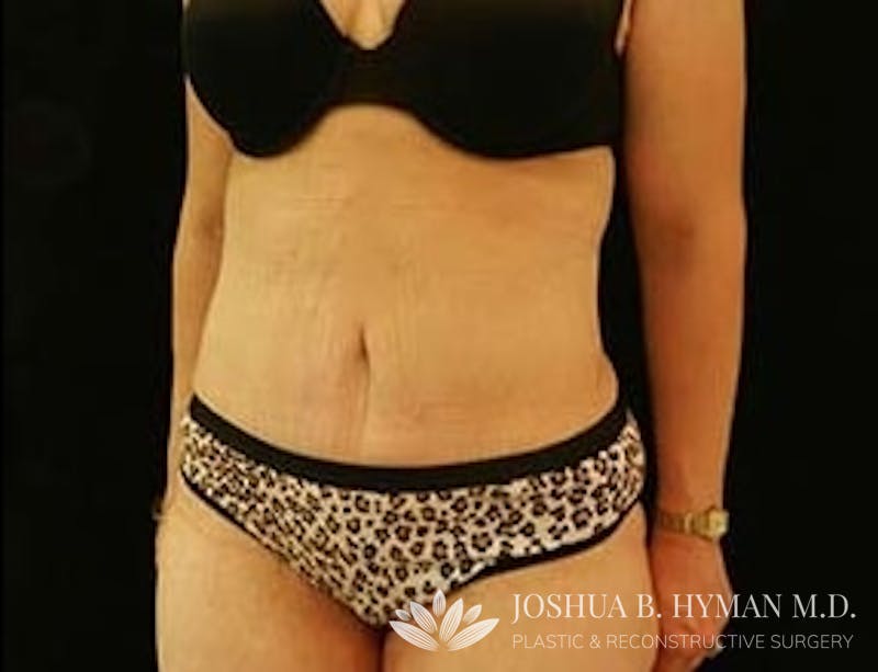 Abdominoplasty Before & After Gallery - Patient 58232383 - Image 2