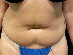 Abdominoplasty Before & After Gallery - Patient 58232385 - Image 1