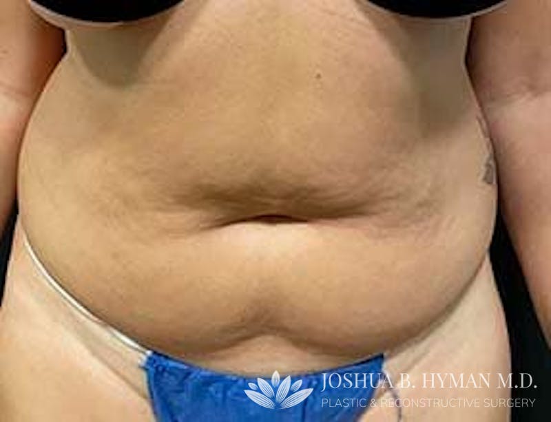 Abdominoplasty Before & After Gallery - Patient 58232385 - Image 1