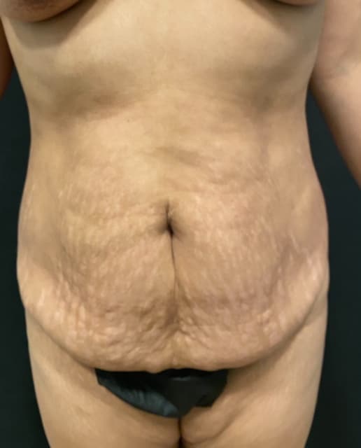 Abdominoplasty Before & After Gallery - Patient 58232393 - Image 1