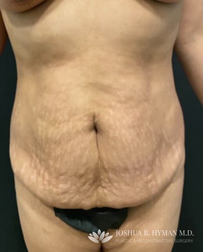 Abdominoplasty Before & After Gallery - Patient 58232393 - Image 1
