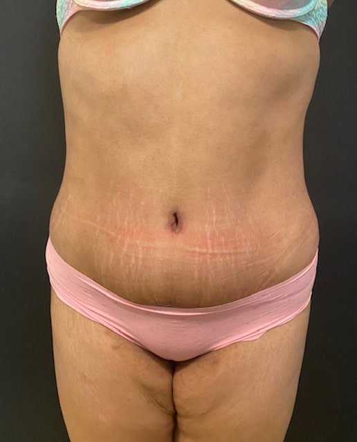 Abdominoplasty Before & After Gallery - Patient 58232393 - Image 2