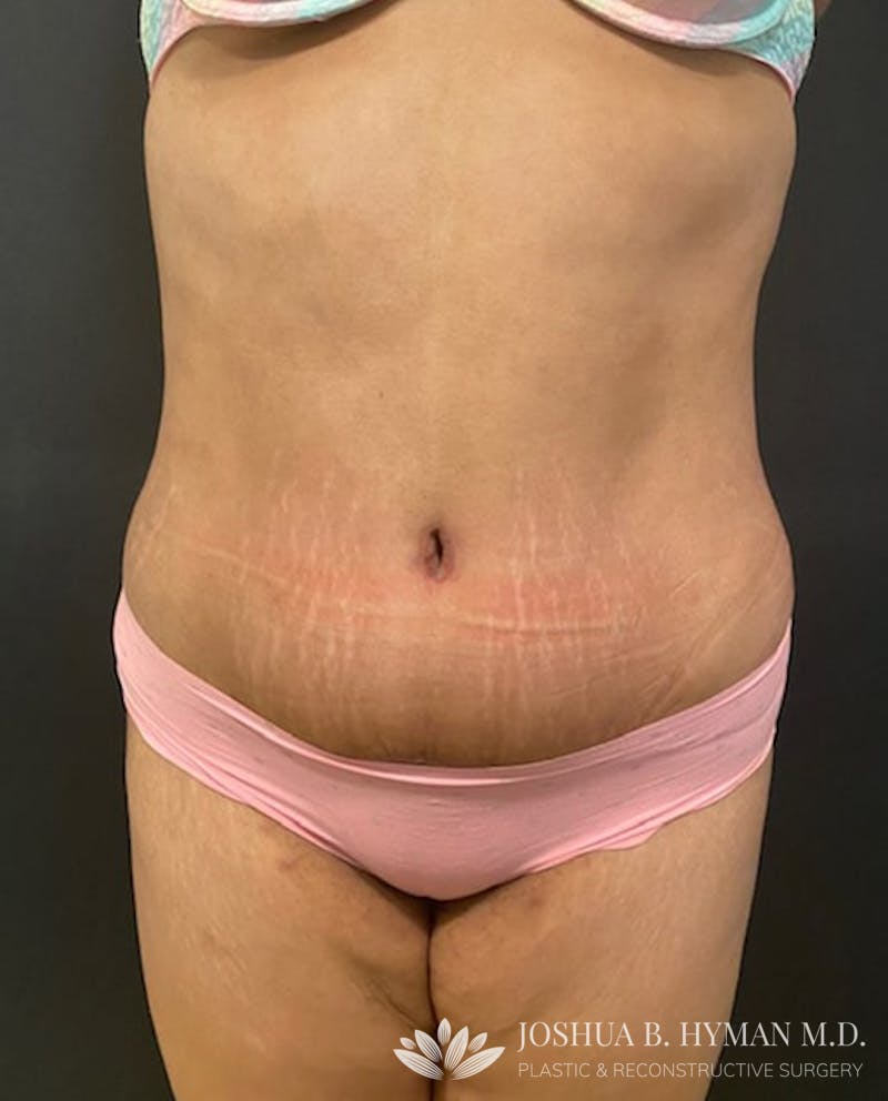 Abdominoplasty Before & After Gallery - Patient 58232393 - Image 2