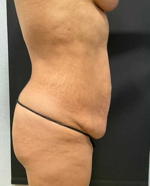 Abdominoplasty Before & After Gallery - Patient 58232393 - Image 3