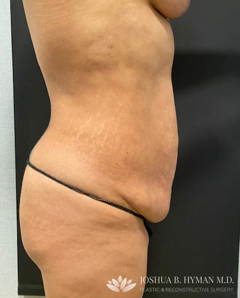 Abdominoplasty Before & After Gallery - Patient 58232393 - Image 3