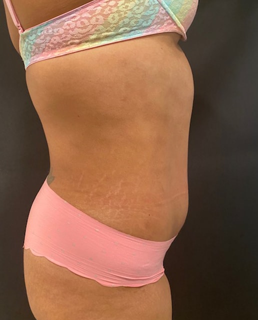 Abdominoplasty Before & After Gallery - Patient 58232393 - Image 4
