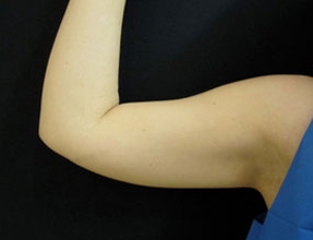 Liposuction Before & After Gallery - Patient 58232394 - Image 1