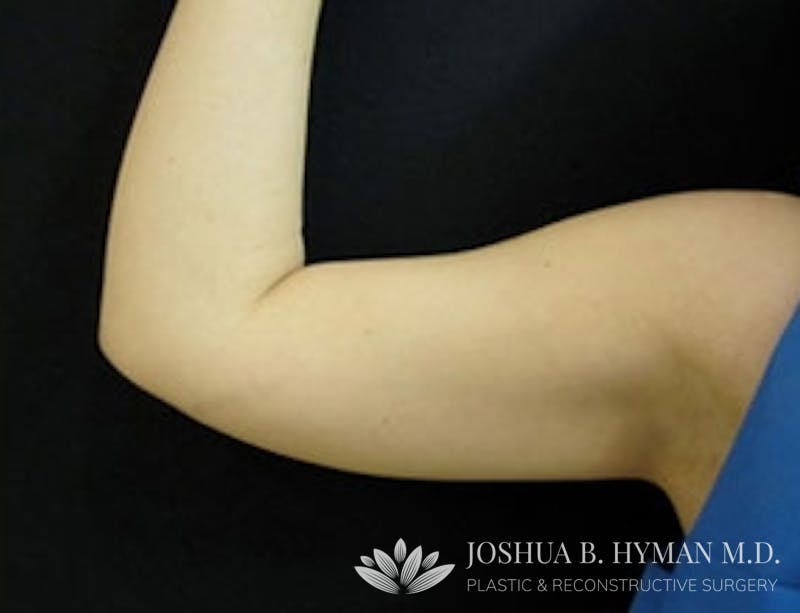 Liposuction Before & After Gallery - Patient 58232394 - Image 1
