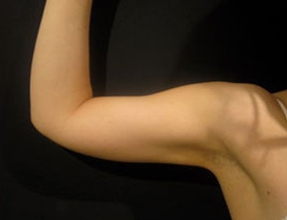 Liposuction Before & After Gallery - Patient 58232394 - Image 2