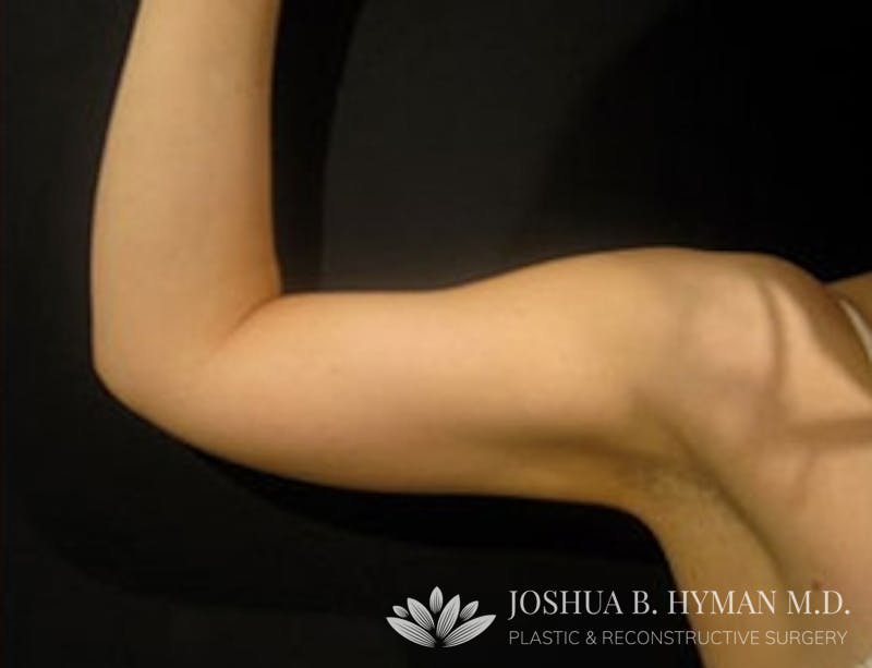 Liposuction Before & After Gallery - Patient 58232394 - Image 2