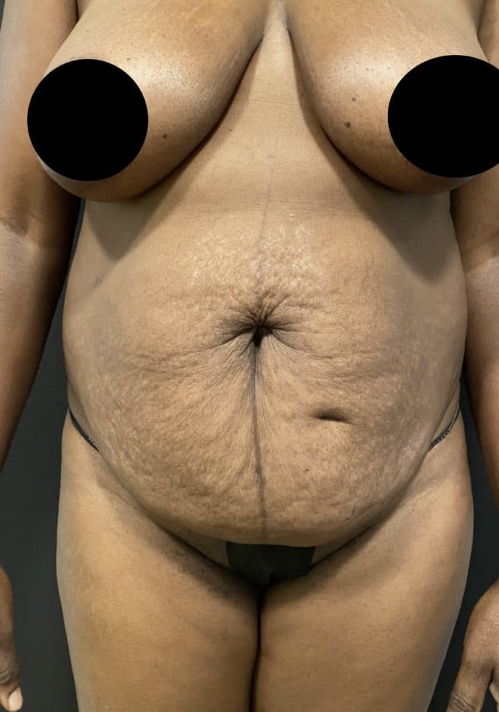 Abdominoplasty Before & After Gallery - Patient 58232395 - Image 1