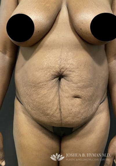 Abdominoplasty Before & After Gallery - Patient 58232395 - Image 1