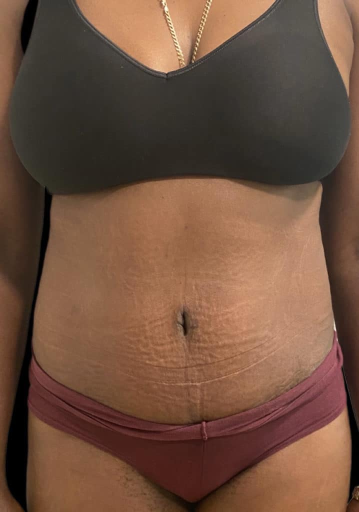 Abdominoplasty Before & After Gallery - Patient 58232395 - Image 2