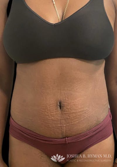 Abdominoplasty Before & After Gallery - Patient 58232395 - Image 2
