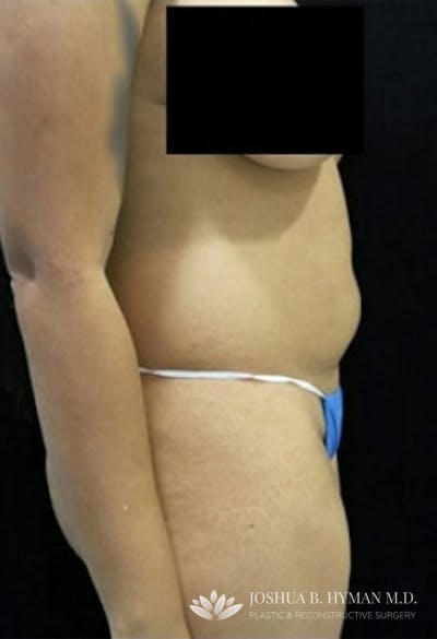 Liposuction Before & After Gallery - Patient 58232398 - Image 1