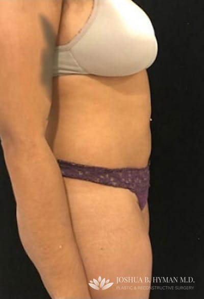 Liposuction Before & After Gallery - Patient 58232398 - Image 2