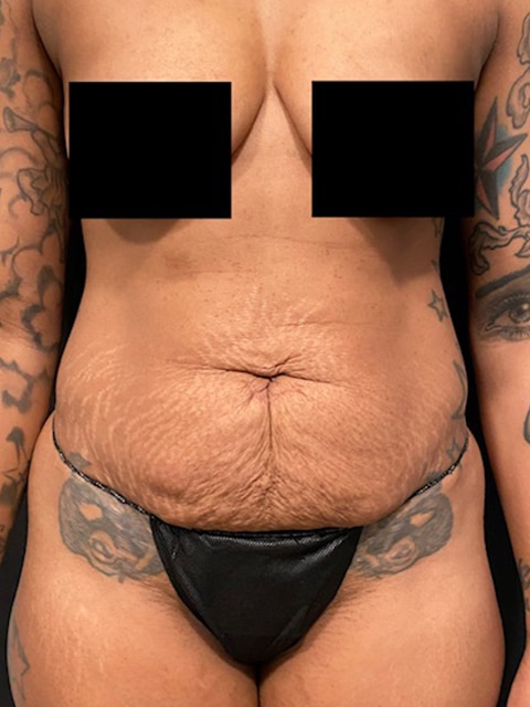 Abdominoplasty Before & After Gallery - Patient 58232400 - Image 1
