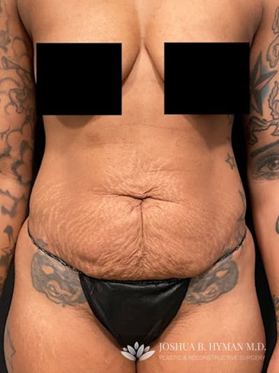 Abdominoplasty Before & After Gallery - Patient 58232400 - Image 1