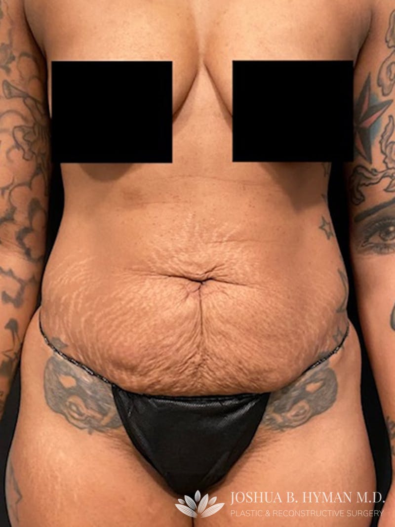 Abdominoplasty Before & After Gallery - Patient 58232400 - Image 1