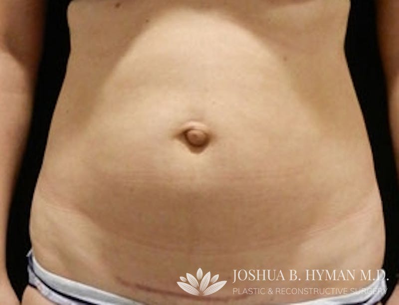 Liposuction Before & After Gallery - Patient 58232401 - Image 1