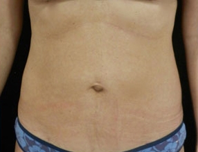Liposuction Before & After Gallery - Patient 58232401 - Image 2
