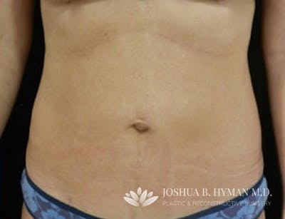 Liposuction Before & After Gallery - Patient 58232401 - Image 2