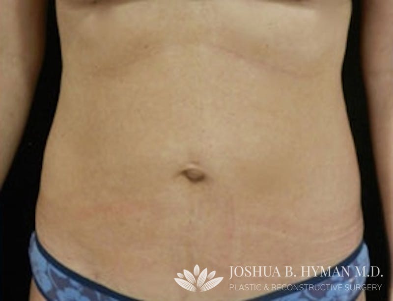 Liposuction Before & After Gallery - Patient 58232401 - Image 2