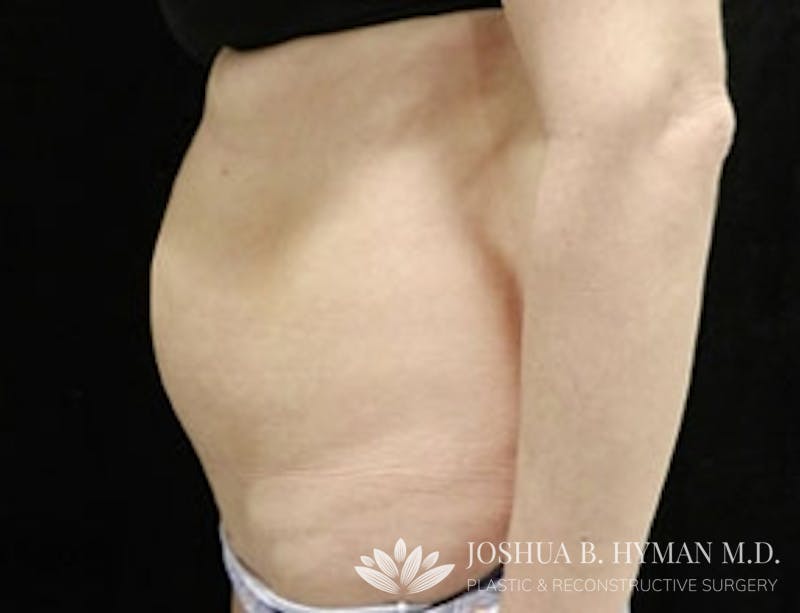 Liposuction Before & After Gallery - Patient 58232401 - Image 3