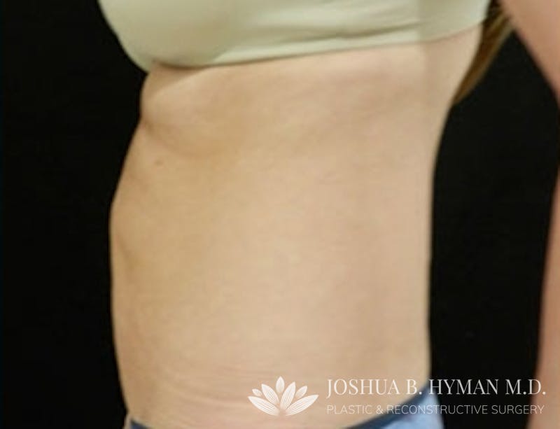 Liposuction Before & After Gallery - Patient 58232401 - Image 4