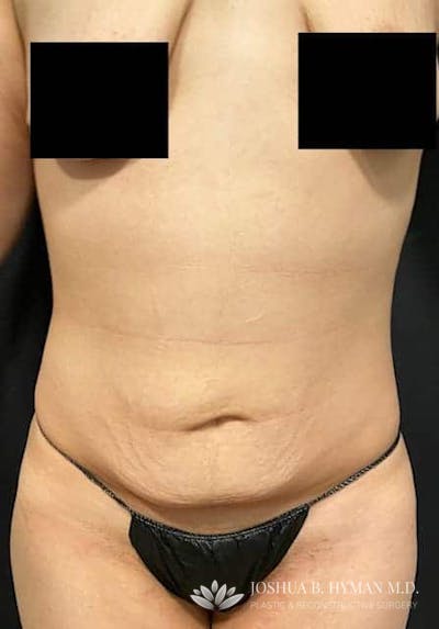 Abdominoplasty Before & After Gallery - Patient 58232405 - Image 1