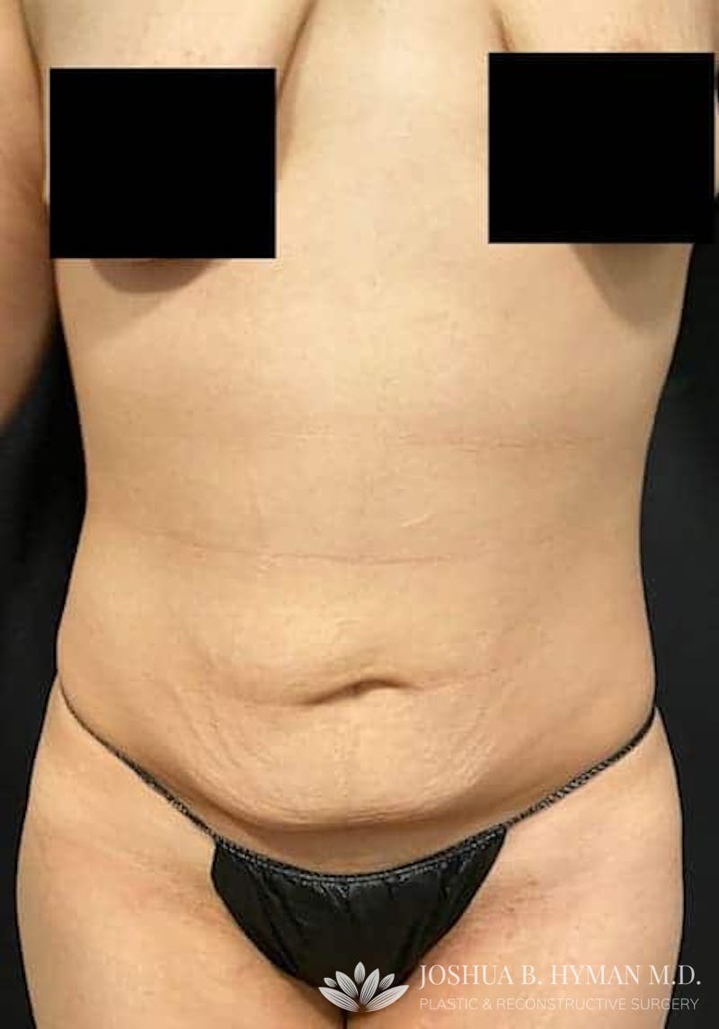 Abdominoplasty Before & After Gallery - Patient 58232405 - Image 1