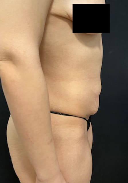 Abdominoplasty Before & After Gallery - Patient 58232405 - Image 3